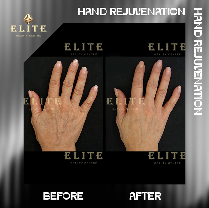 HAND REJUVENATION